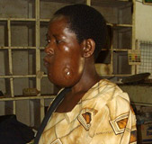 A lady with a cancerous growth on her jaw